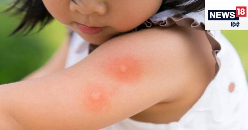 Dengue is more dangerous for children than adults, death occurs quickly, these 5 things are responsible