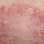 The risk of fungal infection on the skin increases in summer, heat and sweat are the reason
