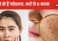 Adult Acne: At the age of 30, the face is full of acne, do these 5 effective things for 3 months, boils, pimples and spots will disappear from the skin