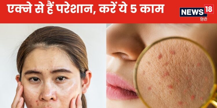 Adult Acne: At the age of 30, the face is full of acne, do these 5 effective things for 3 months, boils, pimples and spots will disappear from the skin