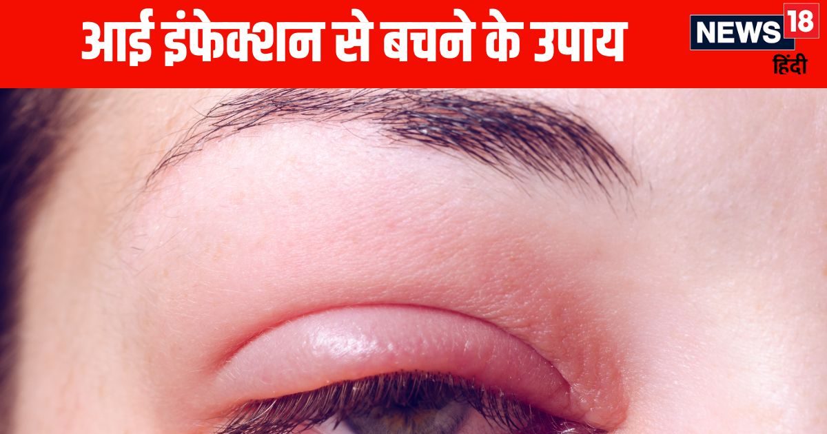 Be cautious of these 5 eye infections during monsoon season, problems can increase if ignored, here are the ways to avoid them