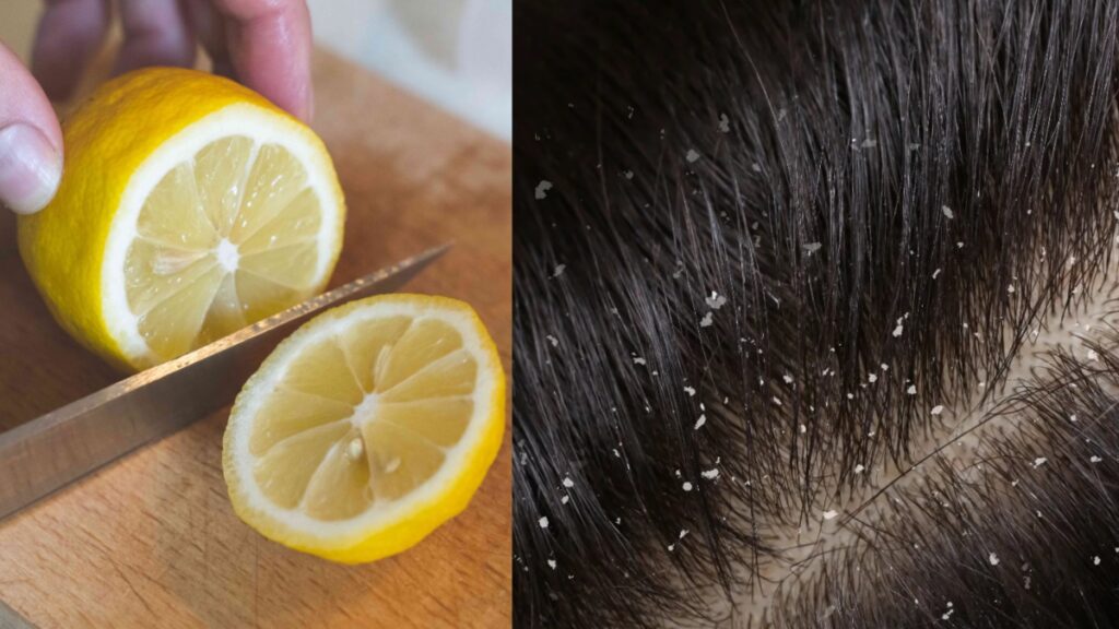 This homemade lemon recipe will get rid of stubborn dandruff from your hair, just use it like this and see the magic - India TV Hindi
