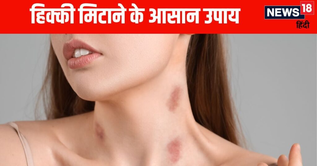 Why are you bothered by hickeys on your neck? These 5 ways can hide your embarrassment and the tension of love bites will end