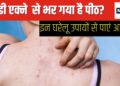 Why do body acne occur on the back and arms? Follow these 5 home remedies to get rid of it, your skin will become flawless