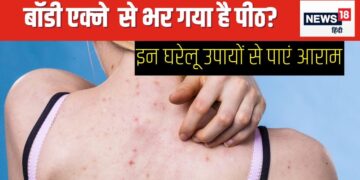 Why do body acne occur on the back and arms? Follow these 5 home remedies to get rid of it, your skin will become flawless