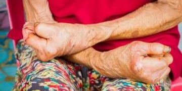 53 percent global leprosy cases in India, legal improvement is necessary to help the affected: Specialist