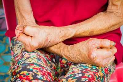 53 percent global leprosy cases in India, legal improvement is necessary to help the affected: Specialist