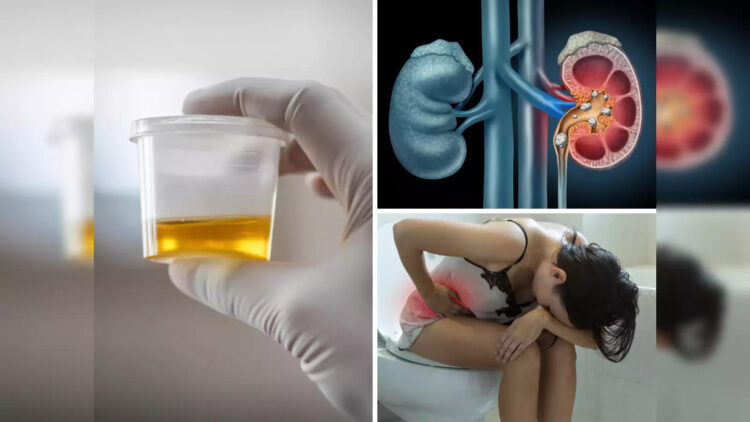 Do stones really form in the urinary tract due to lack of water? Know how much truth is there in these things?