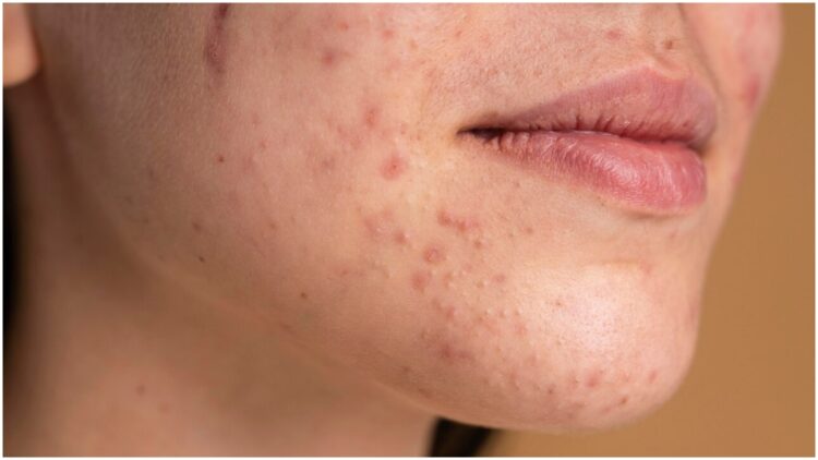 Do stubborn pimples arise again and again on the face? Is there any deficiency of these vitamins - India TV Hindi