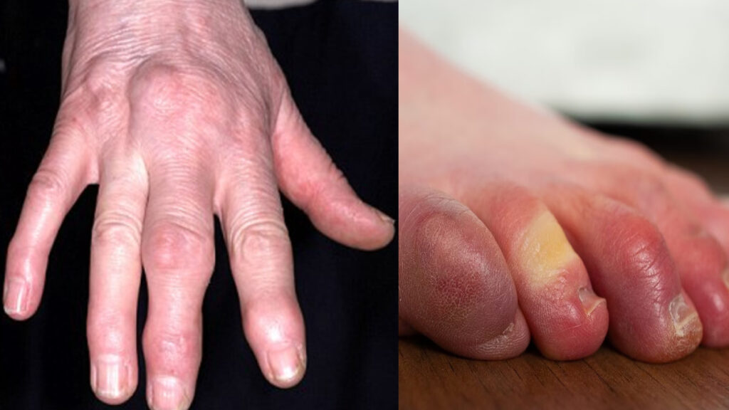 Fingers have turned blue due to cold and hands and feet have started swelling, take these measures - India TV Hindi