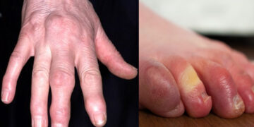 Fingers have turned blue due to cold and hands and feet have started swelling, take these measures - India TV Hindi