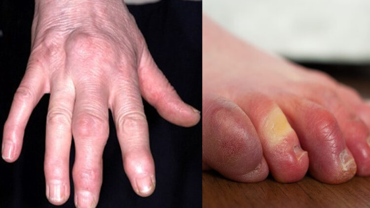Fingers have turned blue due to cold and hands and feet have started swelling, take these measures - India TV Hindi