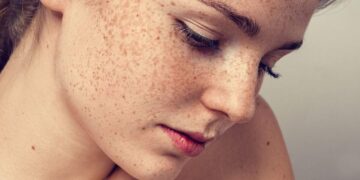 If you are troubled by facial freckles, then adopt this homemade method, the effect will be visible in a week.