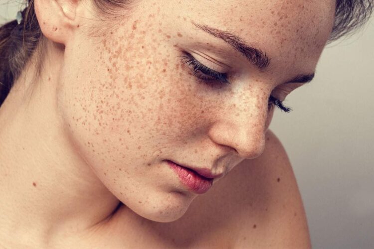 If you are troubled by facial freckles, then adopt this homemade method, the effect will be visible in a week.