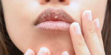 If your lips have cracked and turned black in the harsh winter, then try these home remedies, you will see soft skin in a week.