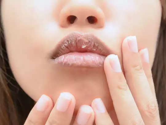 If your lips have cracked and turned black in the harsh winter, then try these home remedies, you will see soft skin in a week.