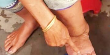 लखनऊ : फाइलेरिया रोधी अभियान में कम्युनिटी रेडियो निभाएंगे अहम भूमिका