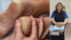 Say boy-boy to cracked heels with proper skin care
