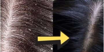 Dandruff is damaging hair and scalp, mix this thing with curd - India tv hindi