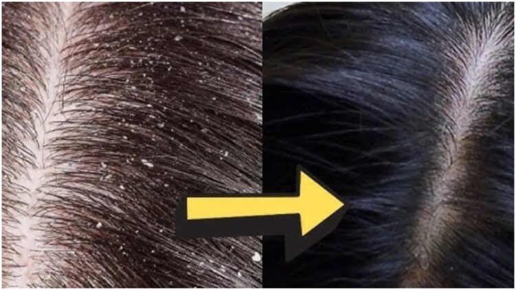 Dandruff is damaging hair and scalp, mix this thing with curd - India tv hindi