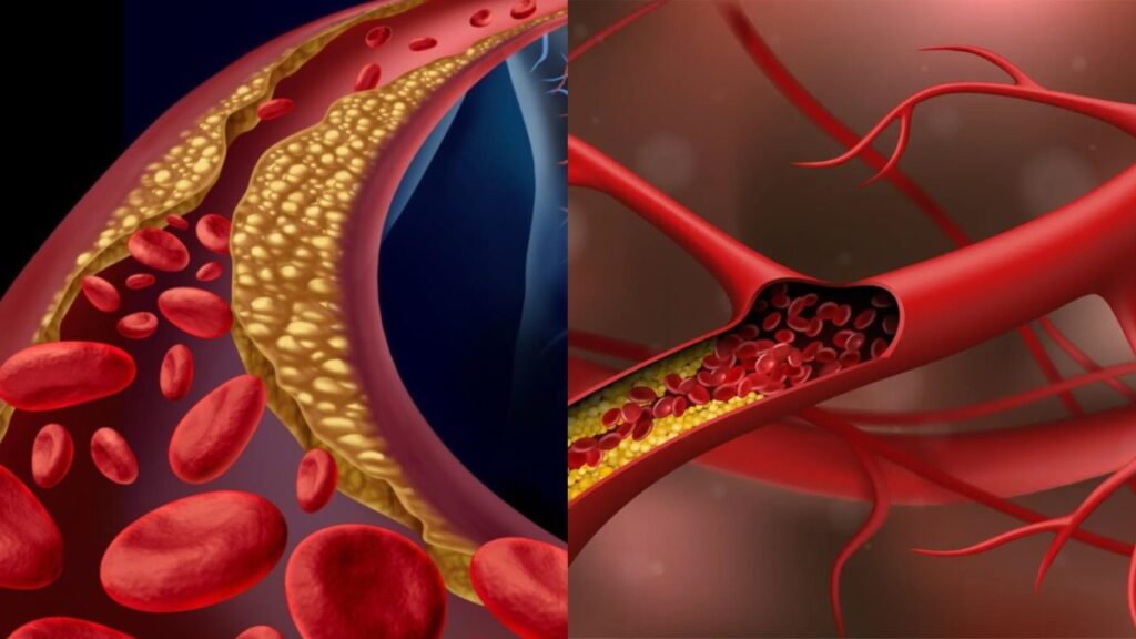Due to these reasons, bad cholesterol starts freezing in the veins, know how to reduce Tv - India tv hindi