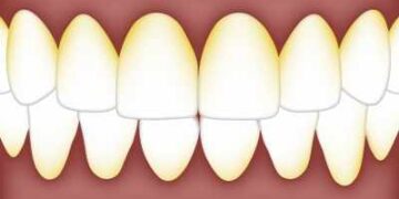 Important to measure bacterial levels present in the mouth to quickly detect Alzheimer's danger: Study