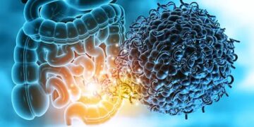 Study told how the risk of multiple sclerosis is connected to Gut microbiome