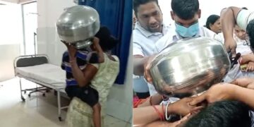 4 -year -old child's head stuck in a steel vessel, doctors saved their lives like this - India tv hindi