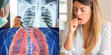 Caution should be taken even after treatment of TB, experts are telling what things - India tv hindi