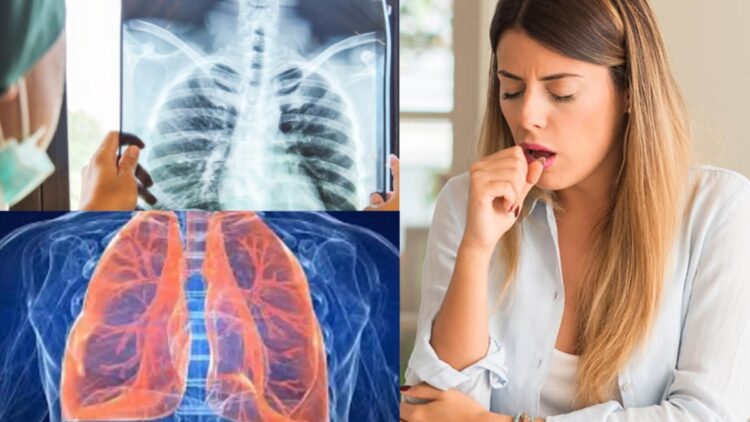 Caution should be taken even after treatment of TB, experts are telling what things - India tv hindi