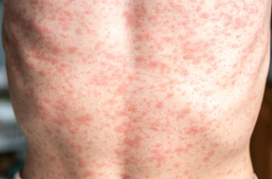 Measles increased concern in Europe: doubled in 2024, WHO said 'most after 1997'