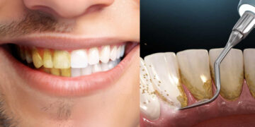 The yellow layer on the teeth will be completely clean, will get rid of stubborn plaque - India tv hindi