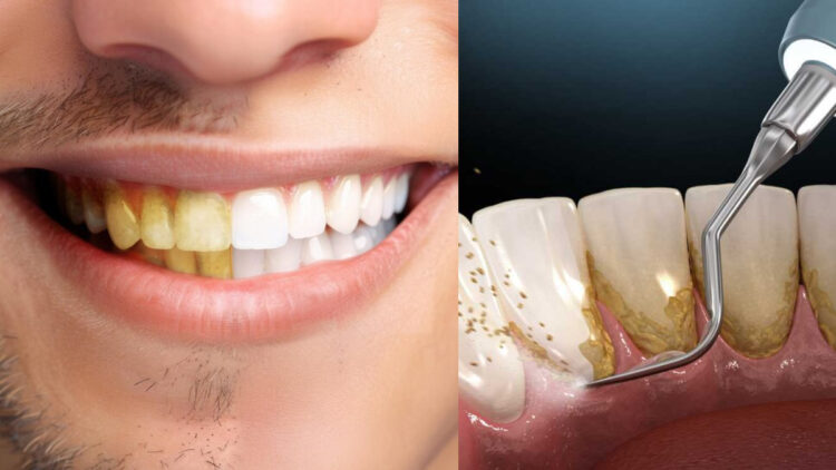 The yellow layer on the teeth will be completely clean, will get rid of stubborn plaque - India tv hindi