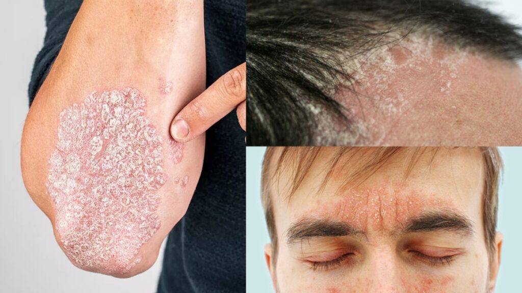 What causes the reasons to psoriasis on the skin, know how many types it is and from it - India tv hindi