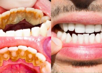 These home remedies will remove stubborn plaque on teeth in minutes, like beads - India tv hindi