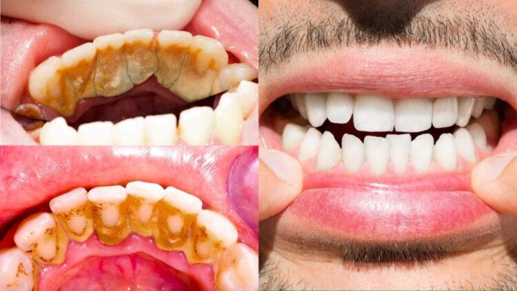 These home remedies will remove stubborn plaque on teeth in minutes, like beads - India tv hindi