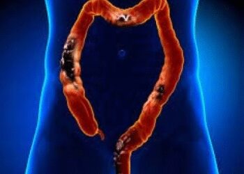 A ray of hope in treating colorectal cancer from gene editing therapy