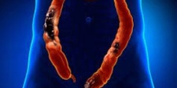 A ray of hope in treating colorectal cancer from gene editing therapy