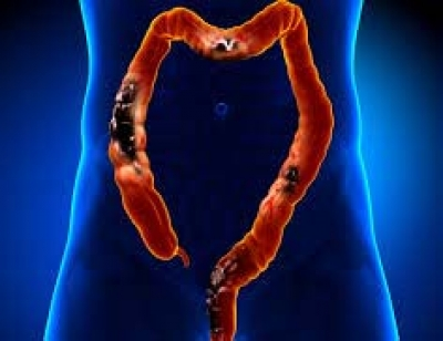 A ray of hope in treating colorectal cancer from gene editing therapy