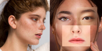Deep and black freckles will become clean, stains will also disappear, do these remedies