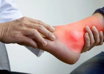 Does high uric acid damage the kidney? Learn how to naturally do uric acid