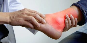 Does high uric acid damage the kidney? Learn how to naturally do uric acid