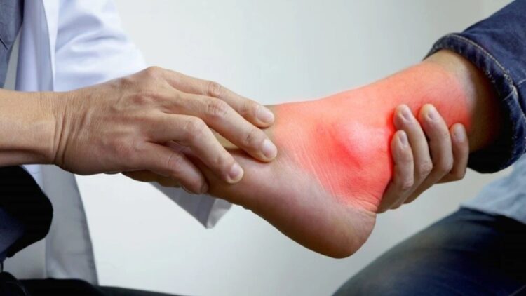 Does high uric acid damage the kidney? Learn how to naturally do uric acid