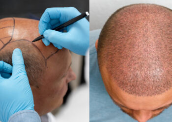 Engineer dies due to hair transplant, know what are side effects
