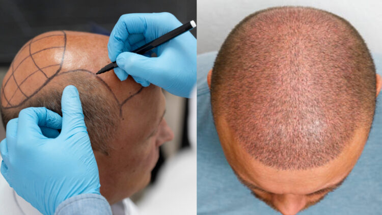 Engineer dies due to hair transplant, know what are side effects