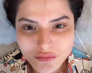 फेशियल एक्यूपंक्चर: चेहरे की चमक बढ़ाने के साथ कई समस्याओं का समाधान है छोटी सी ‘सुई’