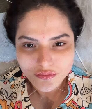 फेशियल एक्यूपंक्चर: चेहरे की चमक बढ़ाने के साथ कई समस्याओं का समाधान है छोटी सी ‘सुई’