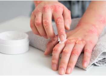 Fungal infection is caused by deficiency of which vitamin? Know the way to remove the deficiency