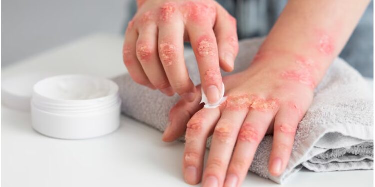 Fungal infection is caused by deficiency of which vitamin? Know the way to remove the deficiency