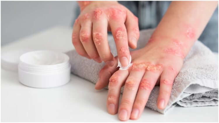 Fungal infection is caused by deficiency of which vitamin? Know the way to remove the deficiency